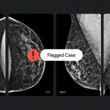 A visual representation of multiple mammograms being scanned by artificial intelligence for signs of breast cancer.